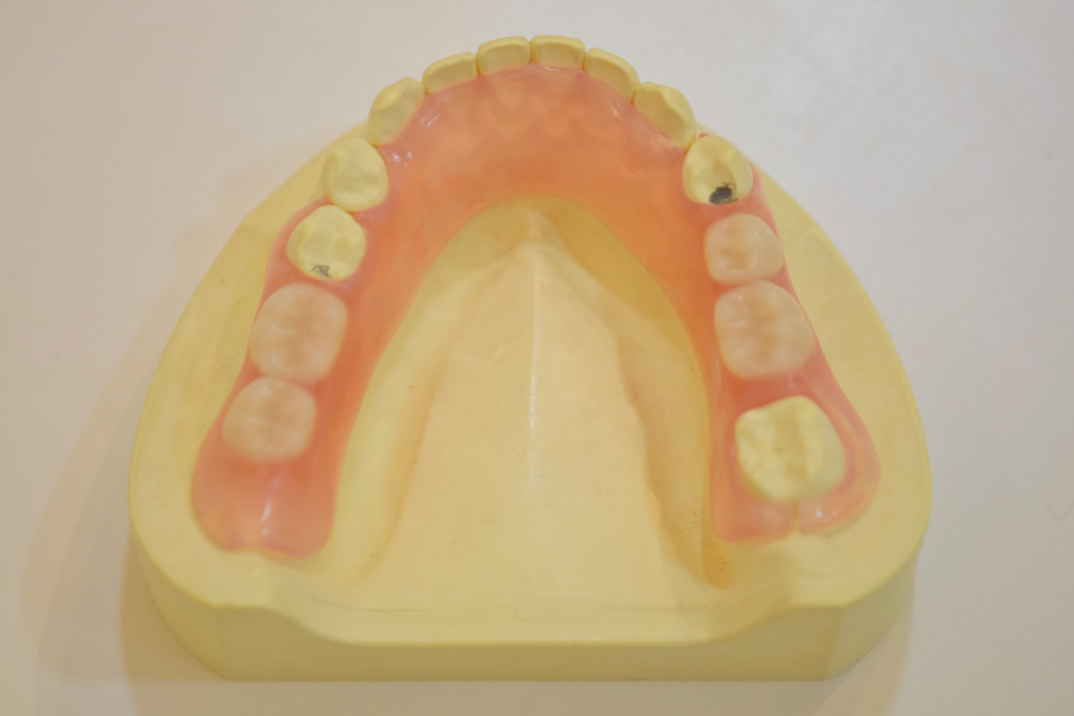 みまや歯科クリニック バルプラスト義歯